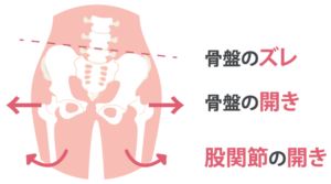 骨盤のズレ 骨盤の開き 股関節の開き